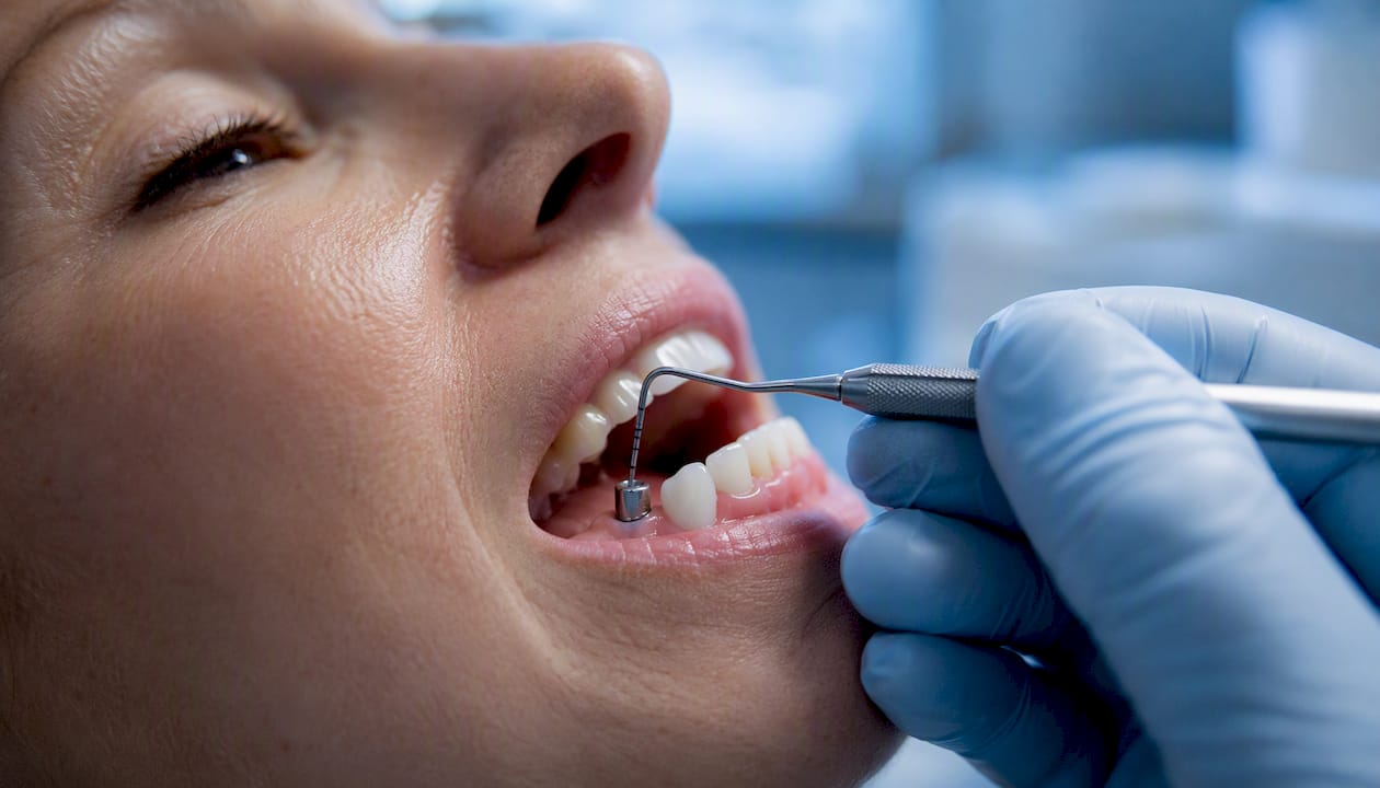 Probe measuring gum around dental implant