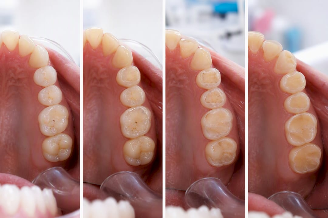 Before and after comparison of teeth grinding damage