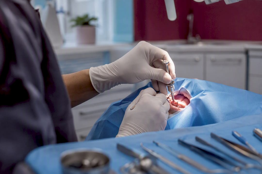 Surgeon placing dental implant post