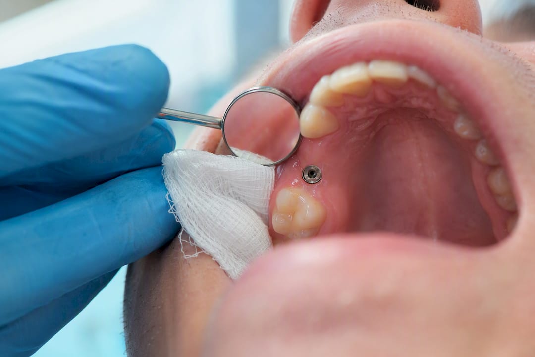 Healing dental implant site with abutment