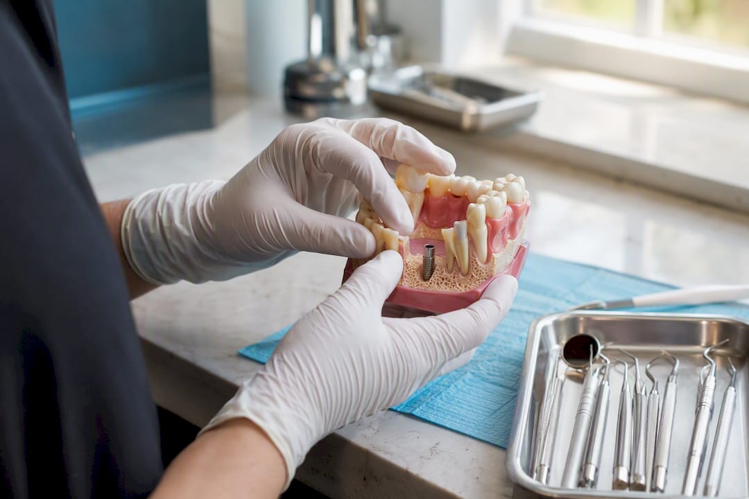 Hands examining dental jaw bone model for implant site