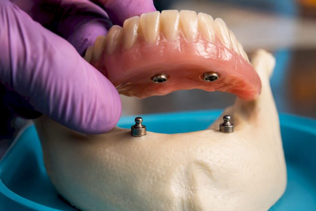 Two implants beneath removable denture