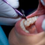 Clinician applying sealant to adult molar