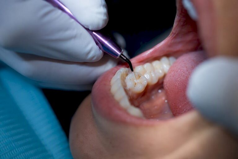 93.75% Retention at 2 Years: Adult Dental Sealants That Work